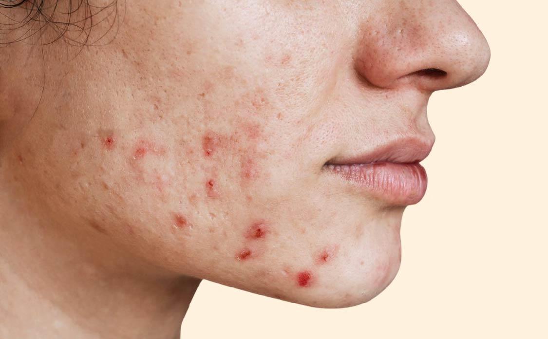 Dermedic Normacne Mattifying Moisturising Cream