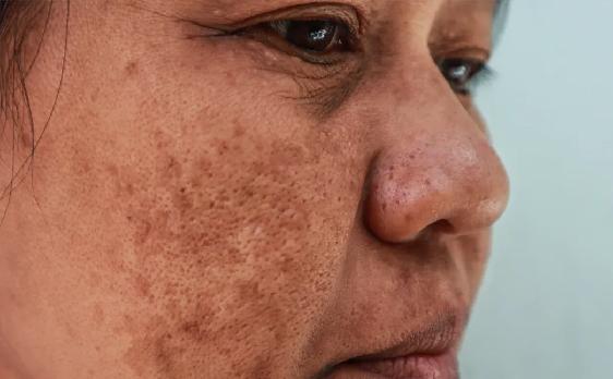 SkinClinic Melanyc Depigmenting Care and Antiaging Serum