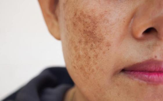 MELUMIN Anti-Dark Spots Concentrated Night Cream