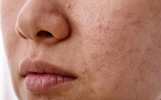 Dermedics Meso Hydra+